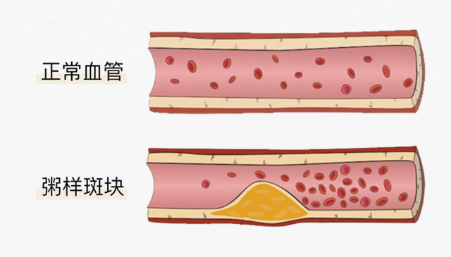 血栓是心梗、腦梗的元兇，很容易找上這些人