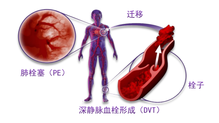 骨科術(shù)后重點(diǎn)關(guān)注的問題—VTE，該如何防治？
