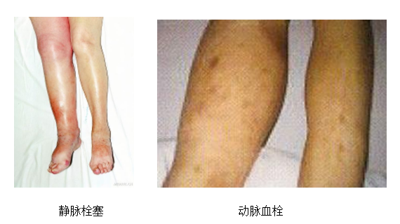 動(dòng)脈血栓和靜脈血栓有什么區(qū)別嗎？