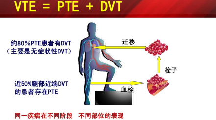 什么是臨床上一致公認(rèn)的VTE防治基礎(chǔ)？