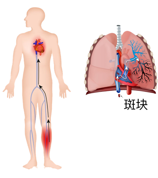 血栓是心梗、腦梗的元兇，很容易找上這些人