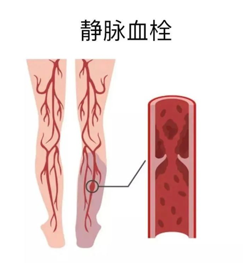 血栓是心梗、腦梗的元兇，很容易找上這些人