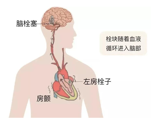 血栓是心梗、腦梗的元兇，很容易找上這些人