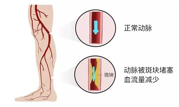 血栓是心梗、腦梗的元兇，很容易找上這些人
