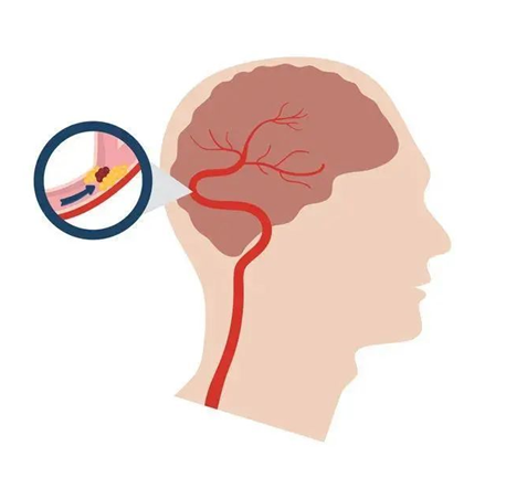 血栓是心梗、腦梗的元兇，很容易找上這些人