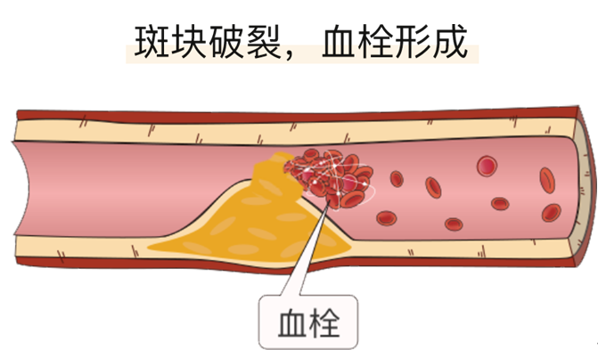 血栓是心梗、腦梗的元兇，很容易找上這些人
