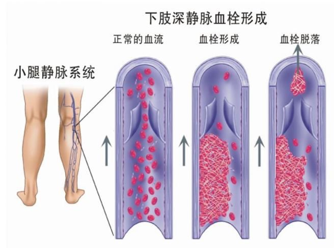 警惕！這個(gè)全球“第三大心血管殺手”，我們?cè)撊绾螒?yīng)對(duì)？