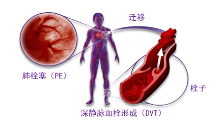 骨科術(shù)后重點(diǎn)關(guān)注的問(wèn)題—VTE，該如何防治？