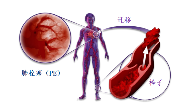 動脈血栓和靜脈血栓有什么區(qū)別嗎？