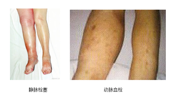 動脈血栓和靜脈血栓有什么區(qū)別嗎？