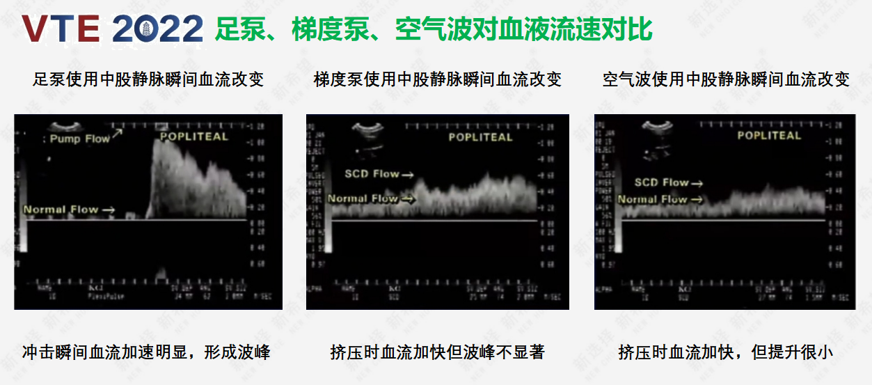 圍術(shù)期患者VTE的預(yù)防，只知道抗凝可不行