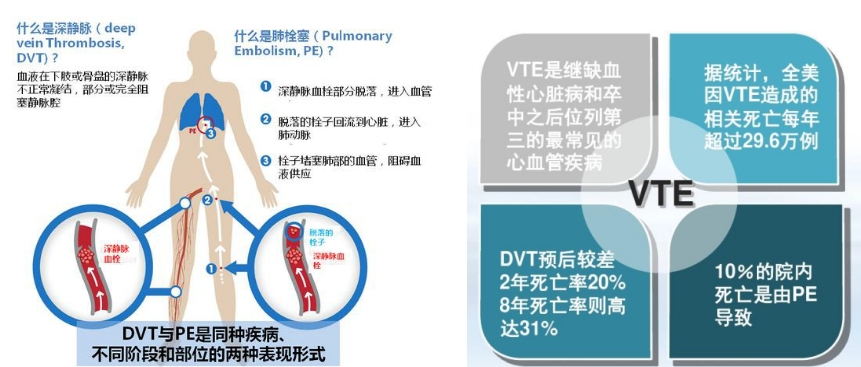 VTE的危害您了解嗎？