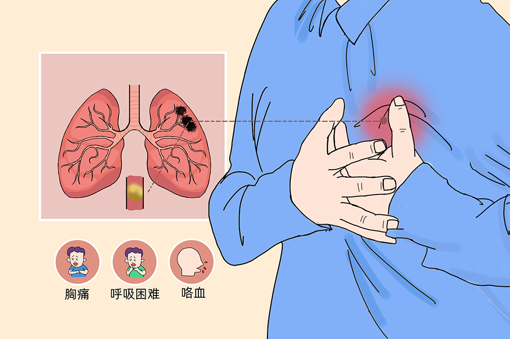 VTE的危害您了解嗎？