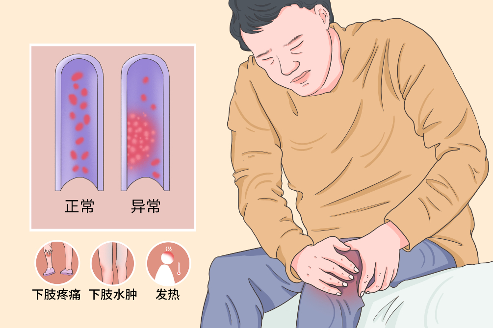 VTE的危害您了解嗎？